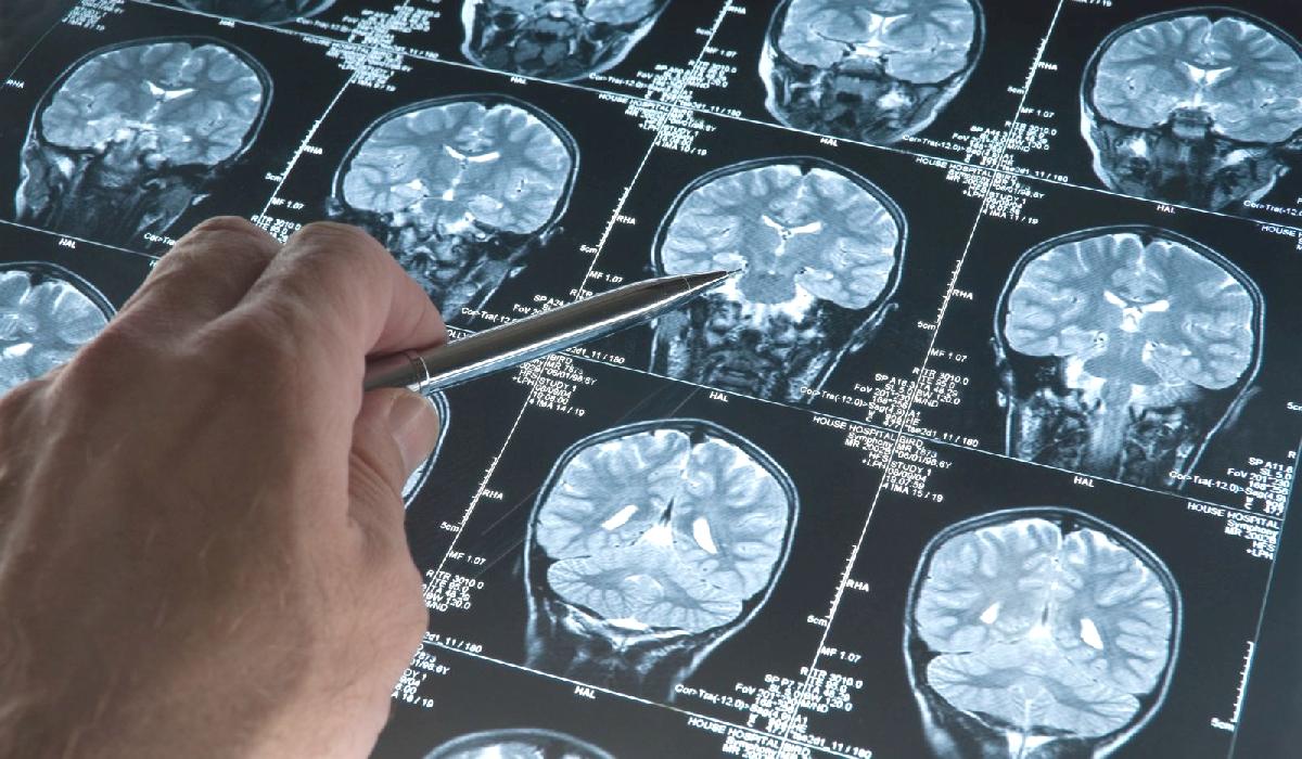 Psikopatların beyinleri diğer insanlardan farklıymış