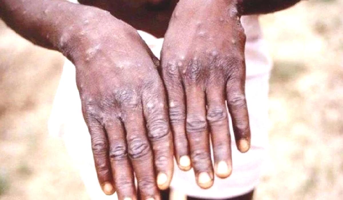 Gana’da M çiçeği yayılıyor